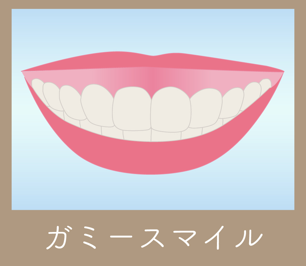 ガミースマイル