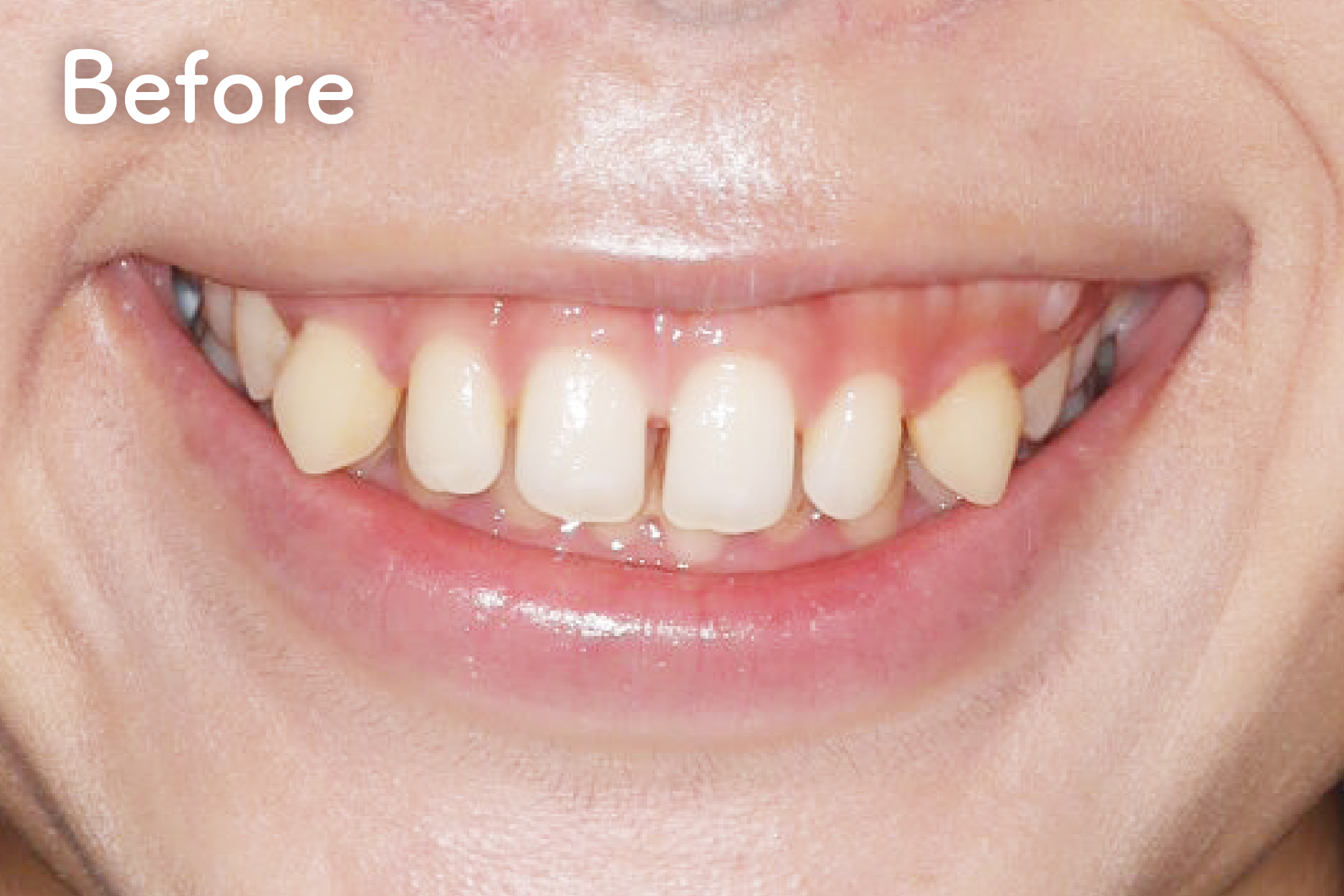 新井矯正歯科・八王子・立川・国分寺